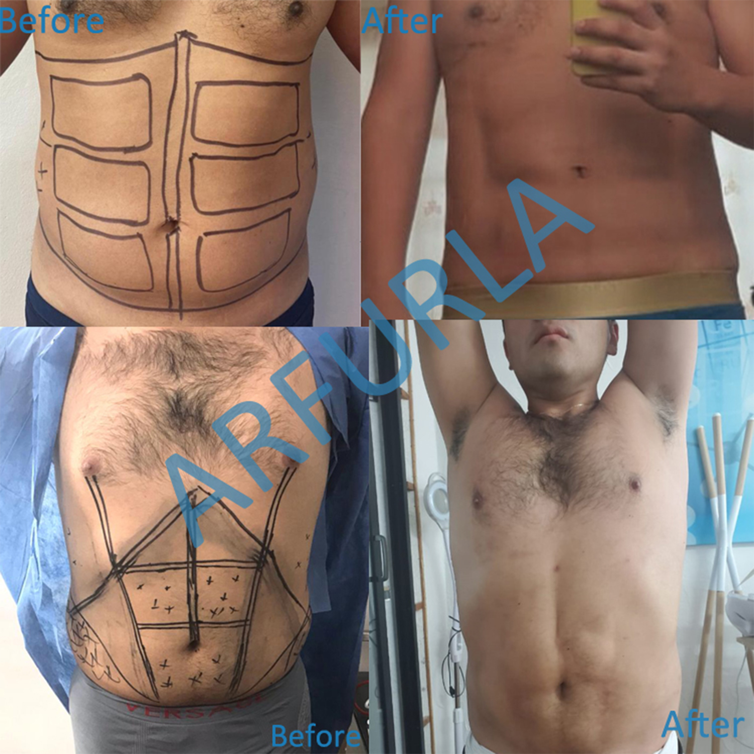 Liposuction laser