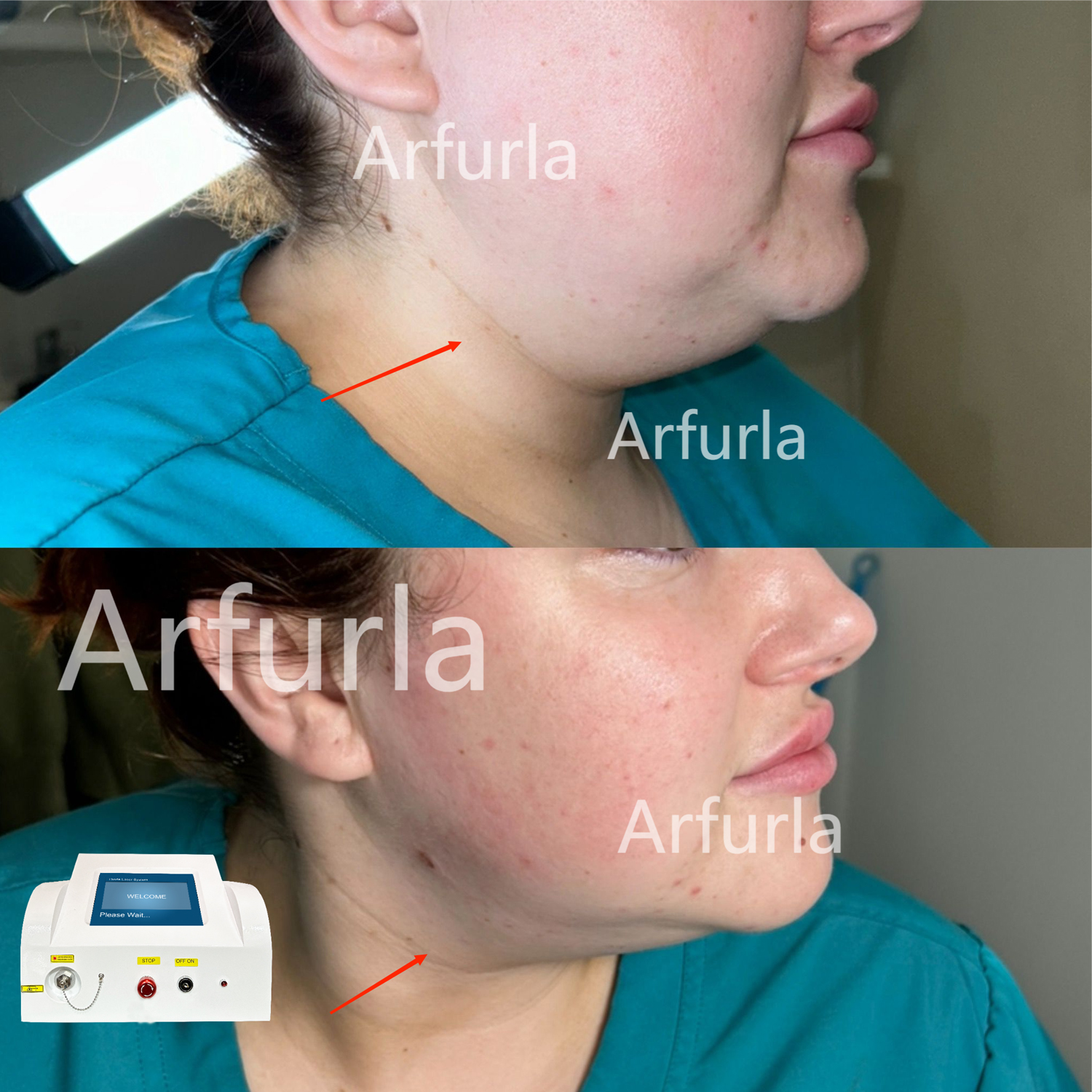 endolift