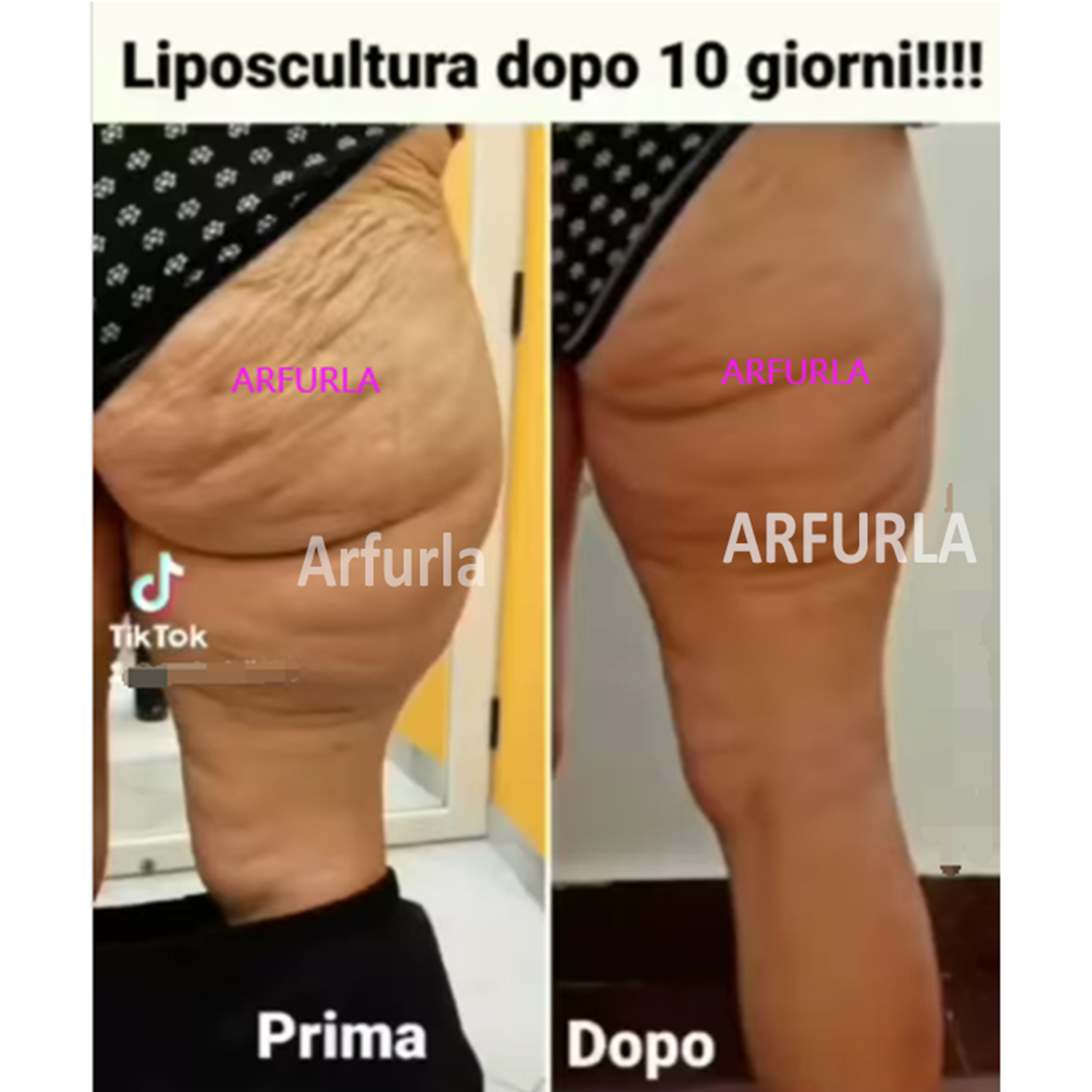 liposutcion