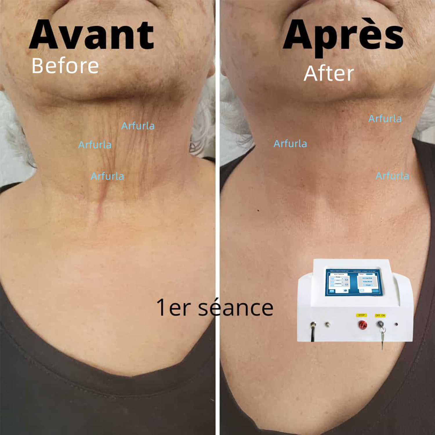 skin rejuvenation 1470
